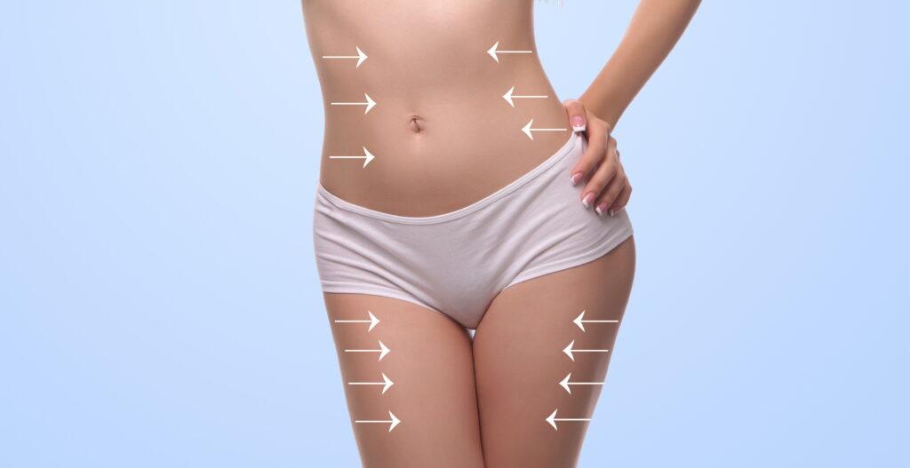 Visualisierung der Kryolipolyse Behandlung mit Fokus auf Fettabbau an Bauch und Beinen – sanfte Koerperformung ohne OP
